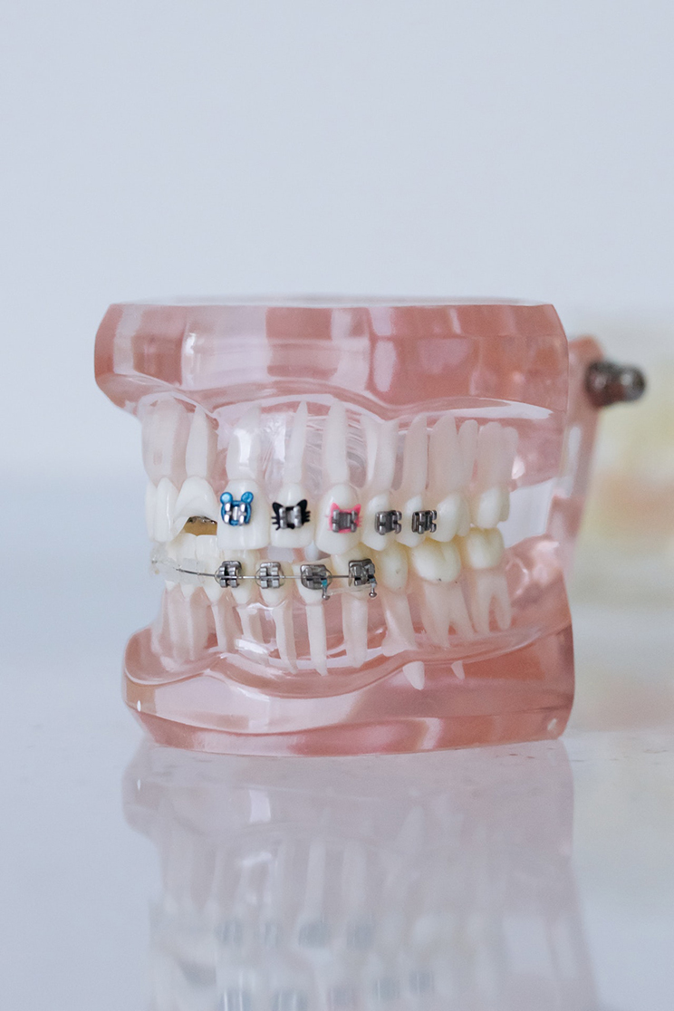 Pexels dental brackets