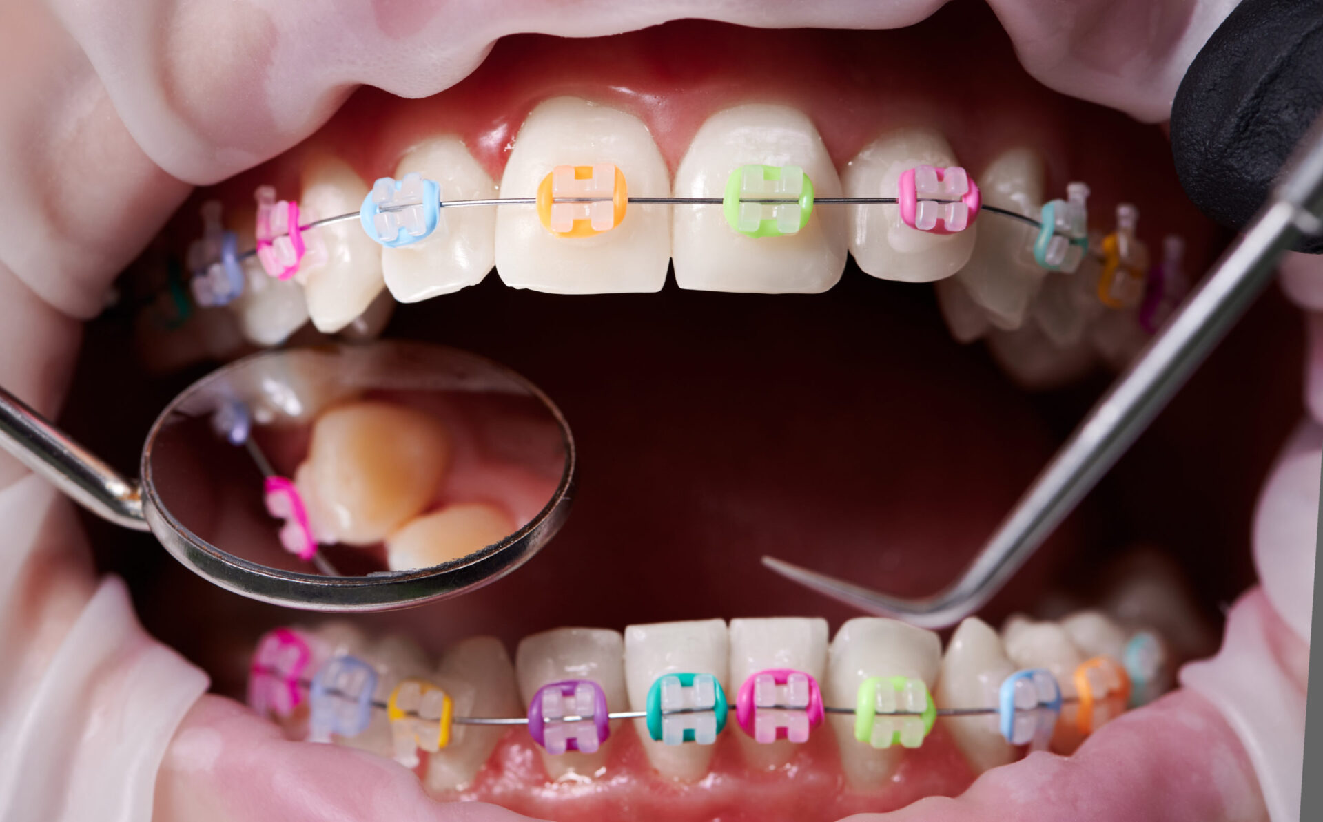 Dental procedure, process of attaching white ceramic braces with a help of colorful rubber bands
